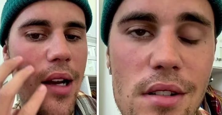 Video: “Pray for Me” – Justin Bieber Reveals Part of His Face Is Paralyzed Video: “Pray for Me” – Justin Bieber Reveals Part of His Face Is Paralyzed